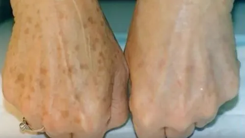 Ihre Altersflecken in kürzester Zeit loswerden Wir haben den einfachen